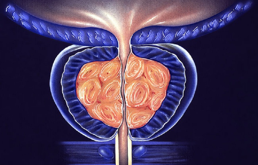 prostatic hyperplasia