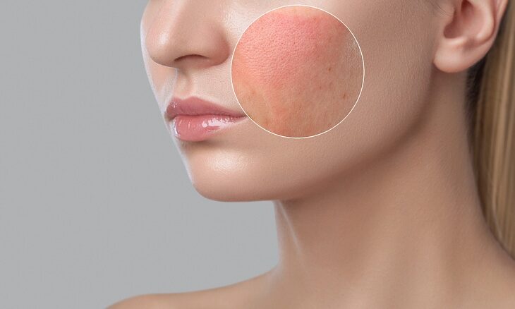 Dermatologists in Treating Allergies