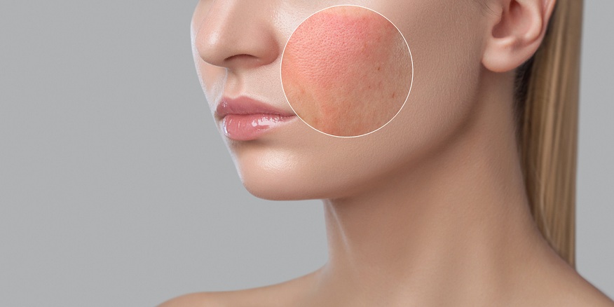 Dermatologists in Treating Allergies