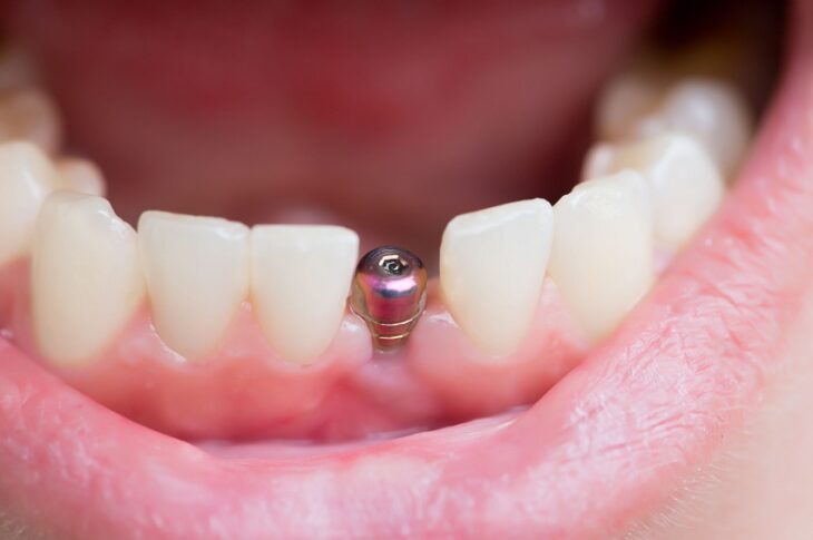 Dental Implants