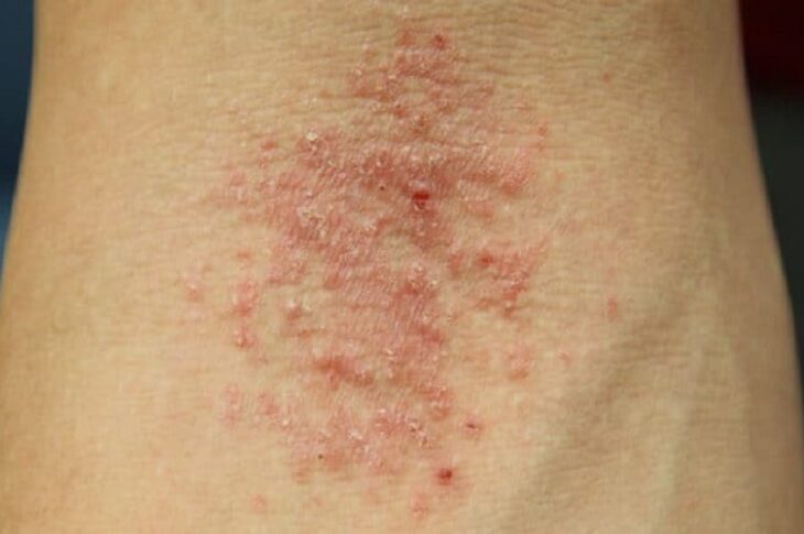 Treatment Of Hives