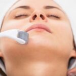 Microneedling in York