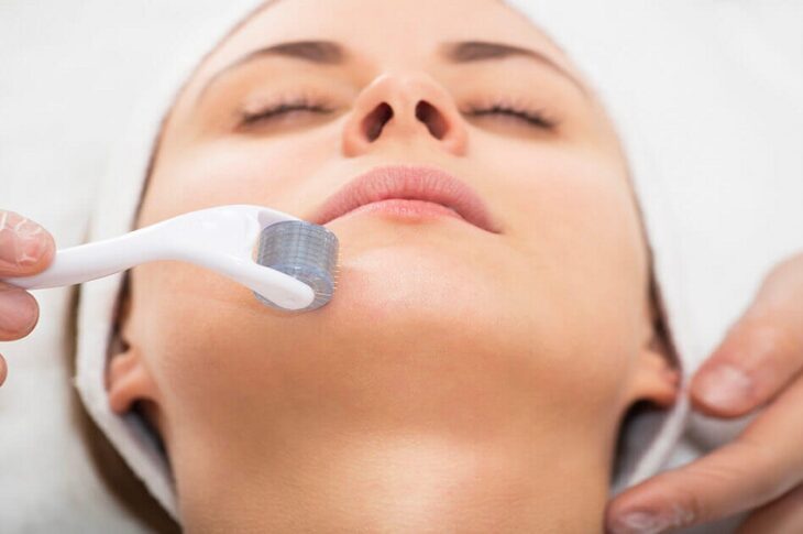 Microneedling in York