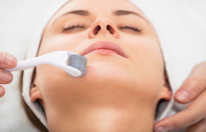 Microneedling in York