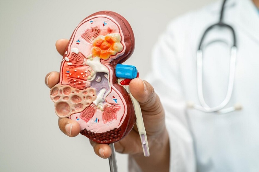 Alport syndrome
