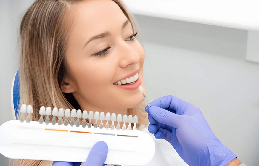 dental veneers in Vancouver, WA