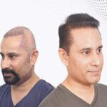 hair transplant in hyderabad