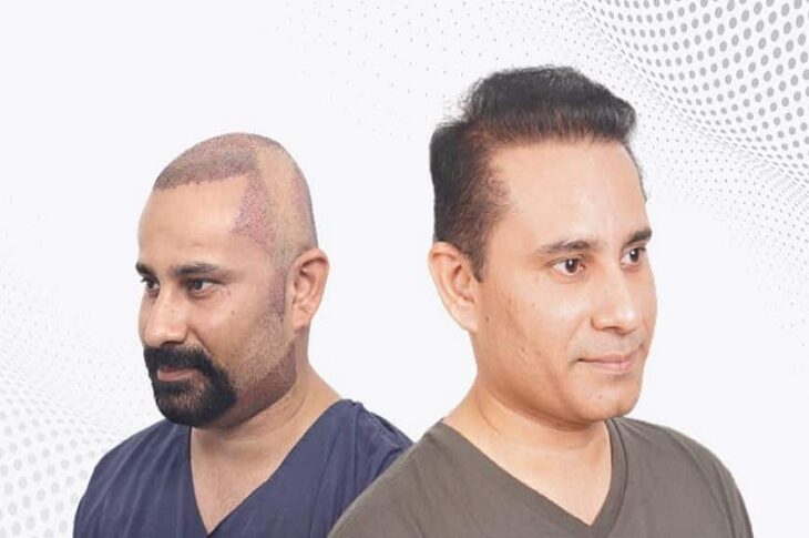 hair transplant in hyderabad