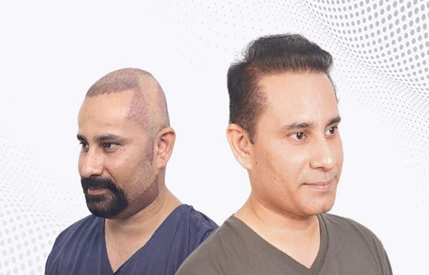 hair transplant in hyderabad